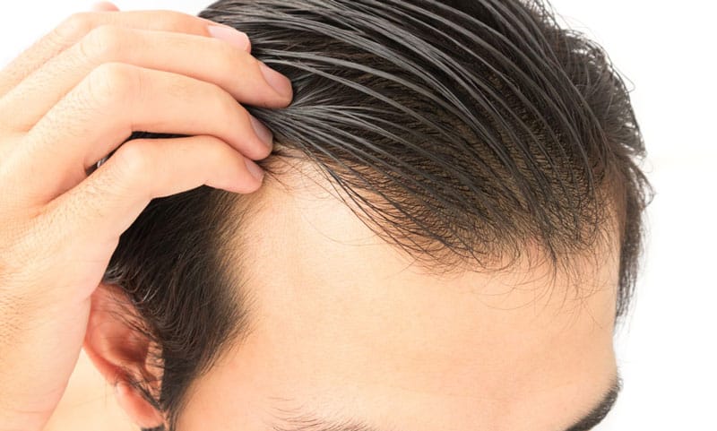 pääkuva PRP- plasmahoito hiustenlähdön ennaltahkäisyyn